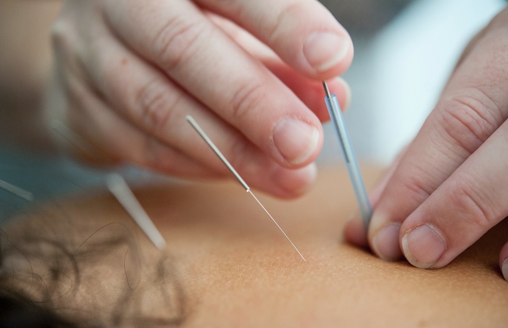 Dry Needling in Montpelier, VA