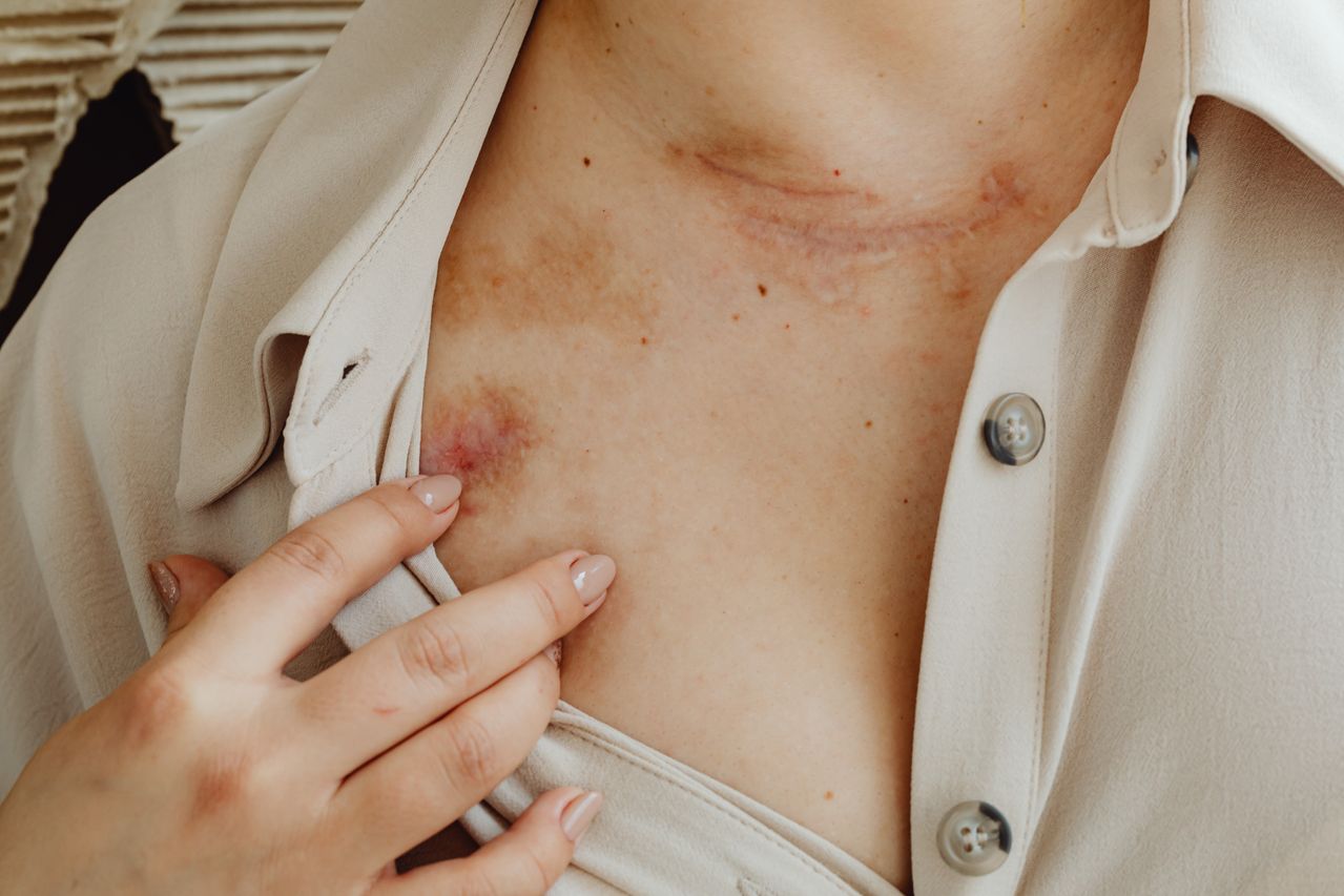 MCAS (Mast Cell Activation Syndrome) Treatment with the SAAT Technique in Montpelier, VA 